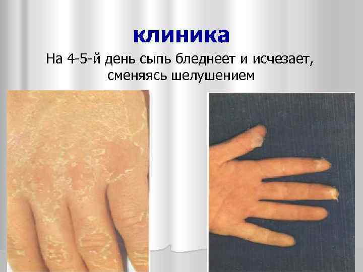 клиника На 4 -5 -й день сыпь бледнеет и исчезает, сменяясь шелушением 