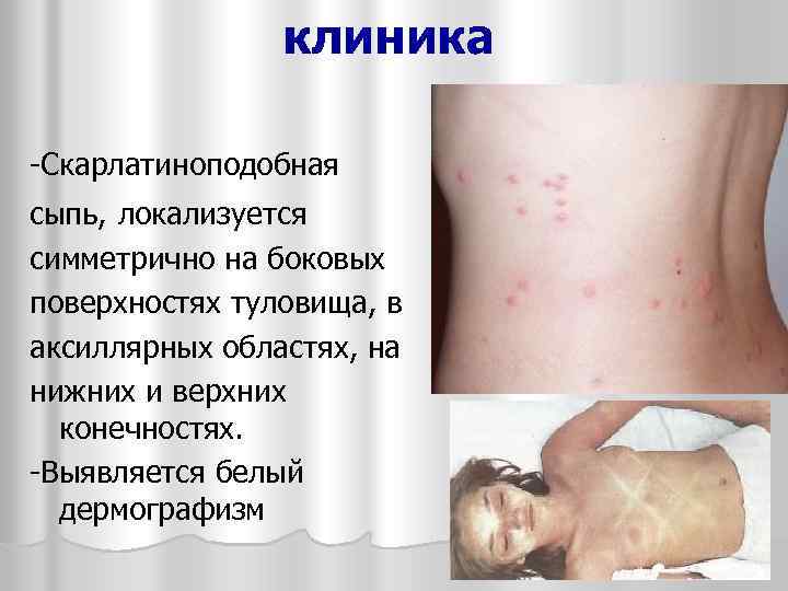 клиника -Скарлатиноподобная сыпь, локализуется симметрично на боковых поверхностях туловища, в аксиллярных областях, на нижних