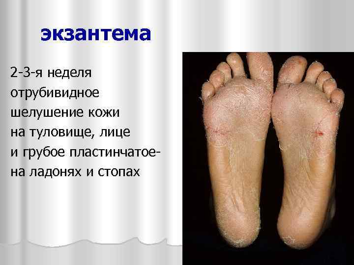 экзантема 2 -3 -я неделя отрубивидное шелушение кожи на туловище, лице и грубое пластинчатоена