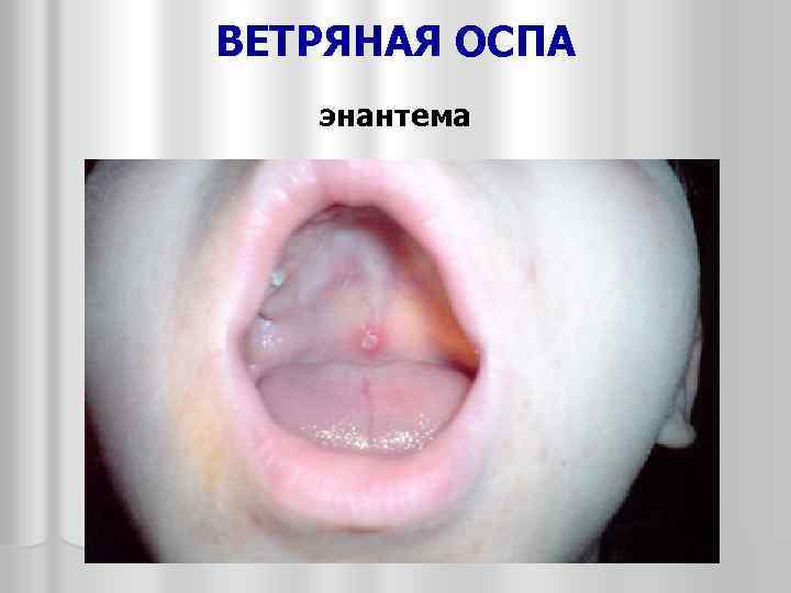 ВЕТРЯНАЯ ОСПА энантема 