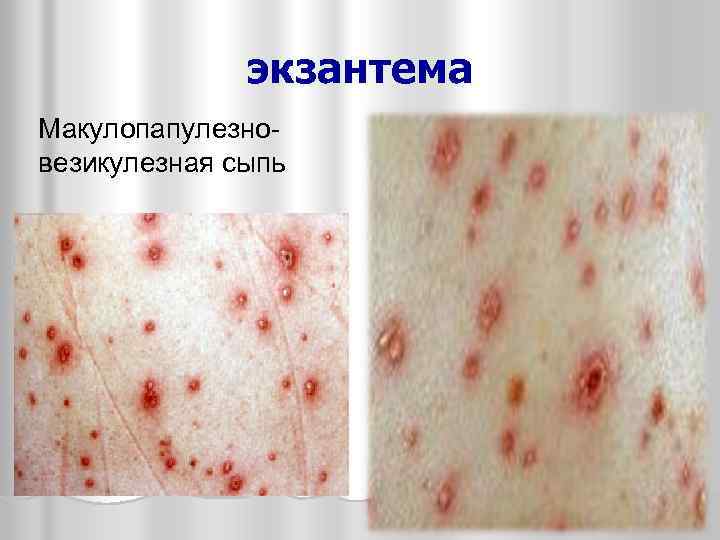 экзантема Макулопапулезновезикулезная сыпь 