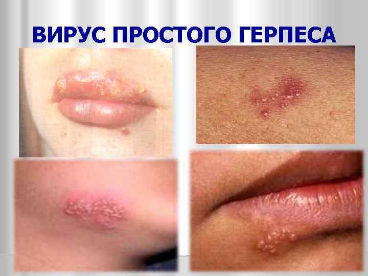 ВИРУС ПРОСТОГО ГЕРПЕСА 