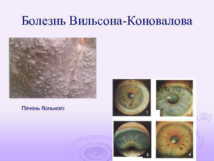 Болезнь Вильсона-Коновалова Печень больного 