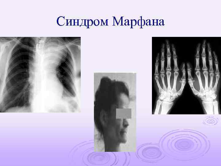 Синдром Марфана 