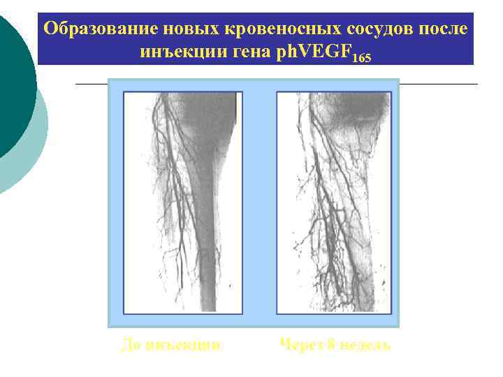 Образование новых кровеносных сосудов после инъекции гена ph. VEGF 165 До инъекции Через 8