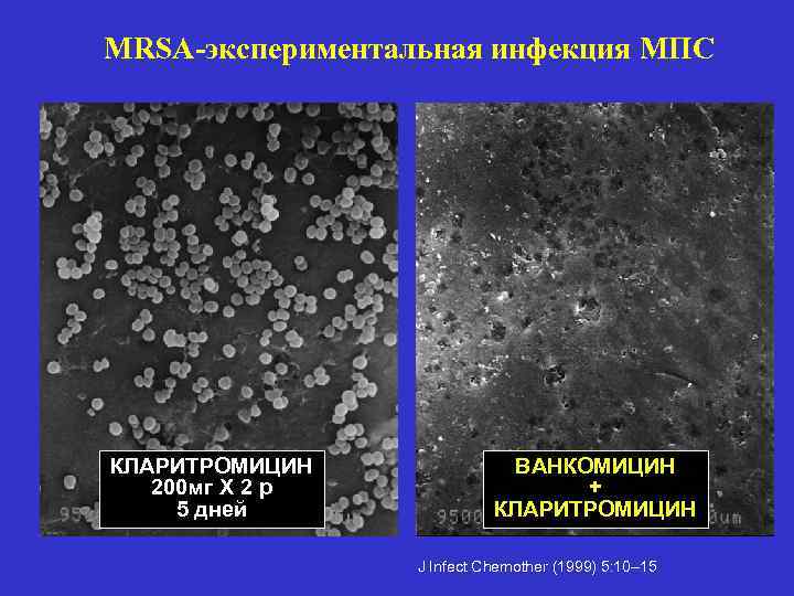 MRSA-экспериментальная инфекция МПС КЛАРИТРОМИЦИН 200 мг Х 2 р 5 дней ВАНКОМИЦИН + КЛАРИТРОМИЦИН