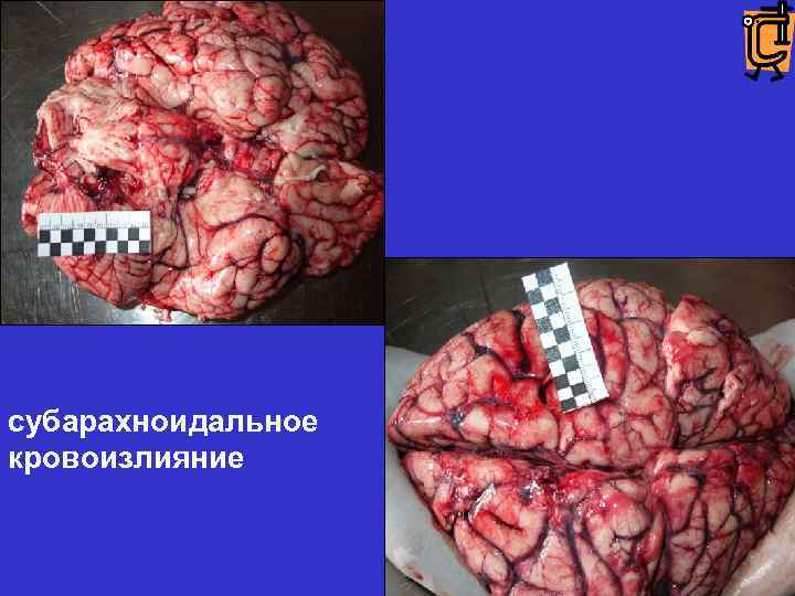 субарахноидальное кровоизлияние 