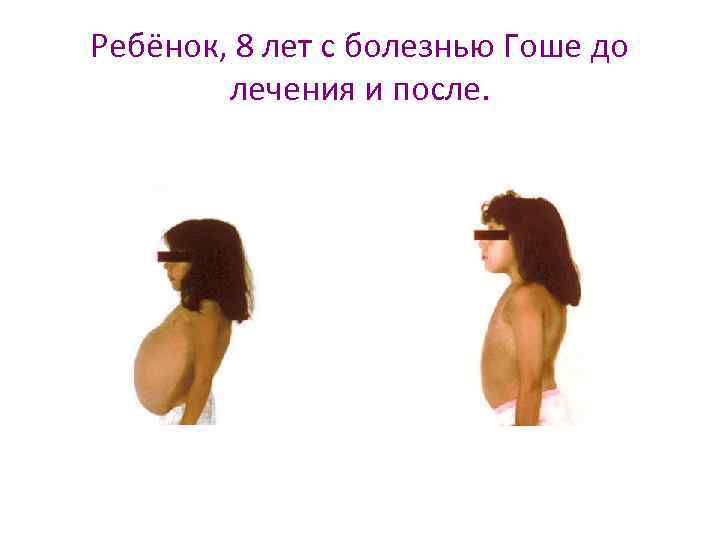 Ребёнок, 8 лет с болезнью Гоше до лечения и после. 