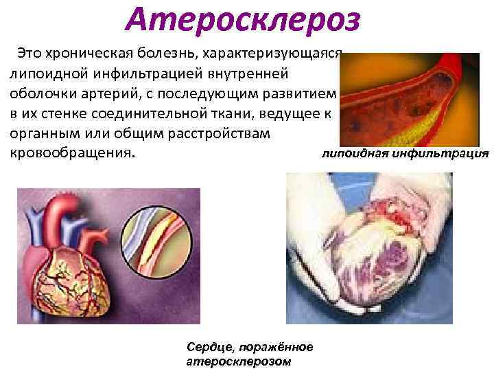 Атеросклероз Это хроническая болезнь, характеризующаяся липоидной инфильтрацией внутренней оболочки артерий, с последующим развитием в