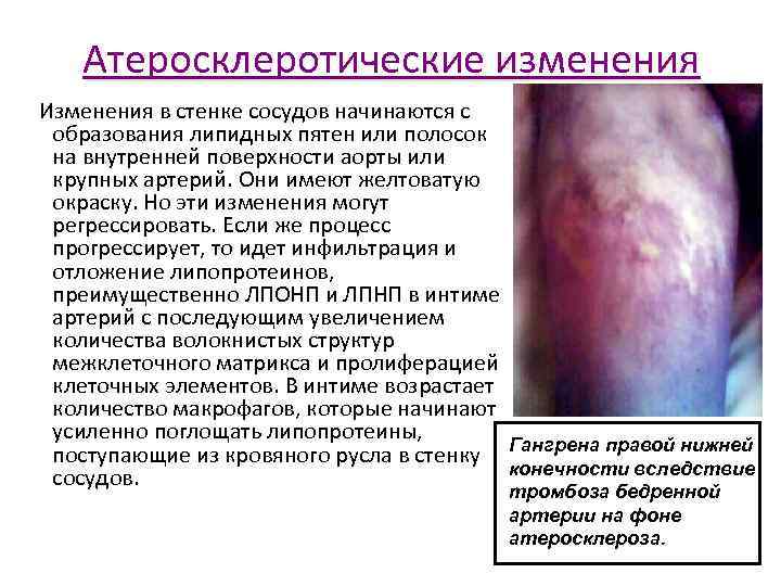 Атеросклеротические изменения Изменения в стенке сосудов начинаются с образования липидных пятен или полосок на