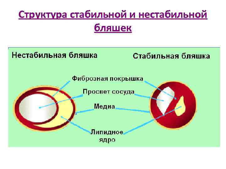 Структура стабильной и нестабильной бляшек 