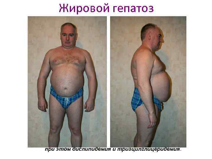 Жировой гепатоз при этом дислипидемия и триацилглицеридемия. 