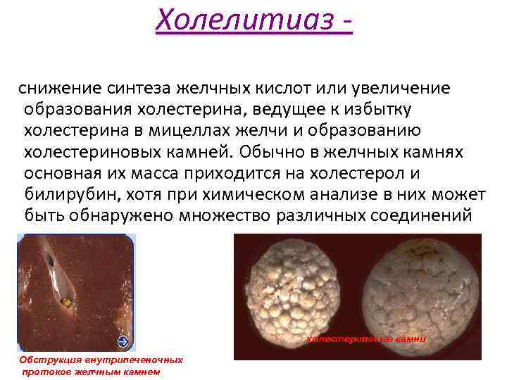 Холелитиаз снижение синтеза желчных кислот или увеличение образования холестерина, ведущее к избытку холестерина в