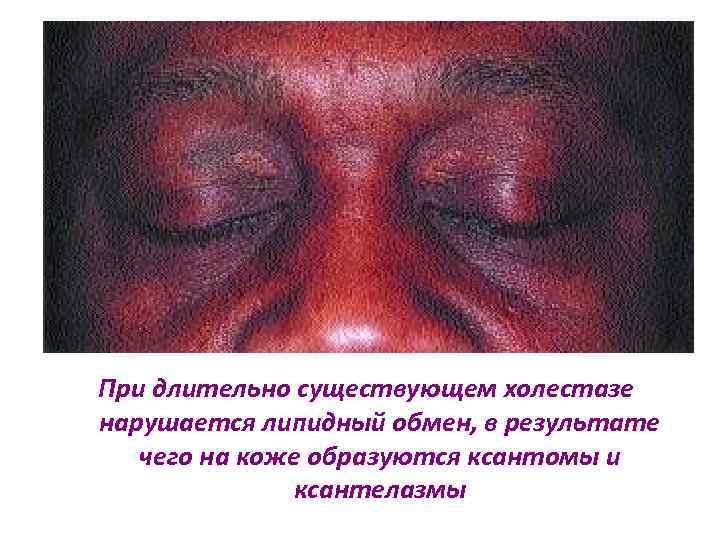 При длительно существующем холестазе нарушается липидный обмен, в результате чего на коже образуются ксантомы