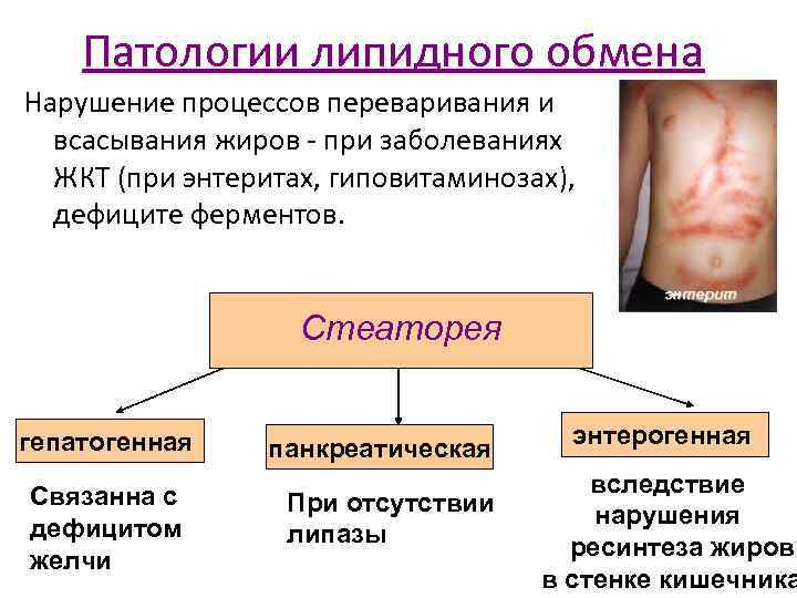 Патологии липидного обмена Нарушение процессов переваривания и всасывания жиров - при заболеваниях ЖКТ (при