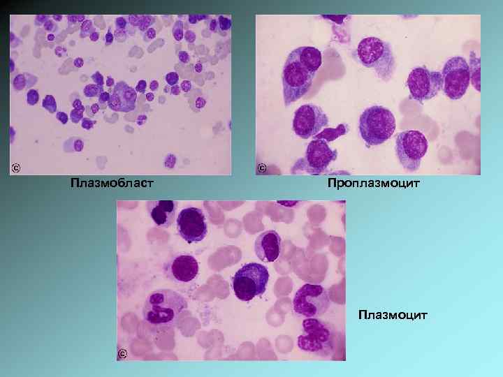Плазмобласт Проплазмоцит Плазмоцит 