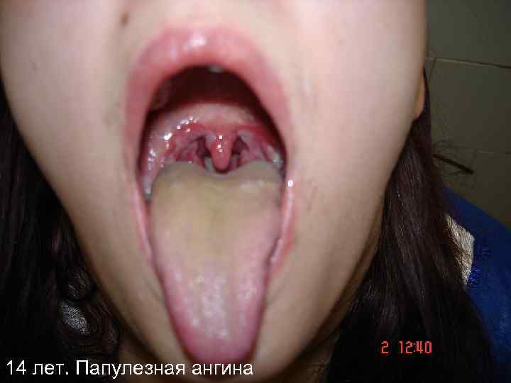 14 лет. Папулезная ангина 