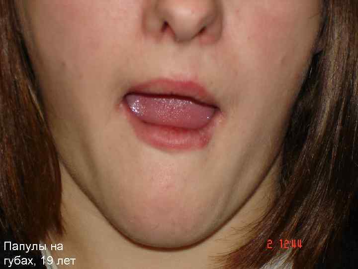 Папулы на губах, 19 лет 