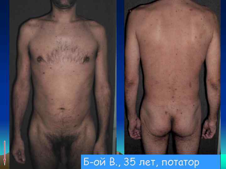 Б-ой В. , 35 лет, потатор 