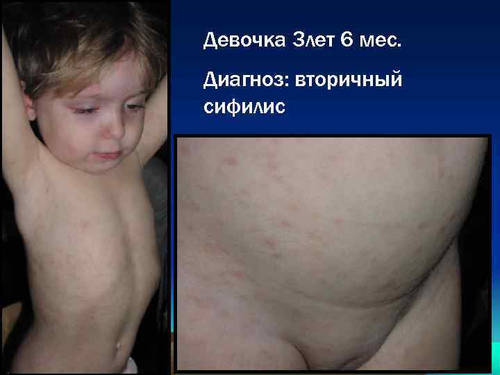 Девочка 3 лет 6 мес. Диагноз: вторичный сифилис 