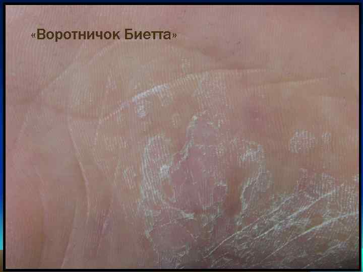  «Воротничок Биетта» 