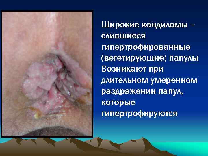 Широкие кондиломы – слившиеся гипертрофированные (вегетирующие) папулы Возникают при длительном умеренном раздражении папул, которые