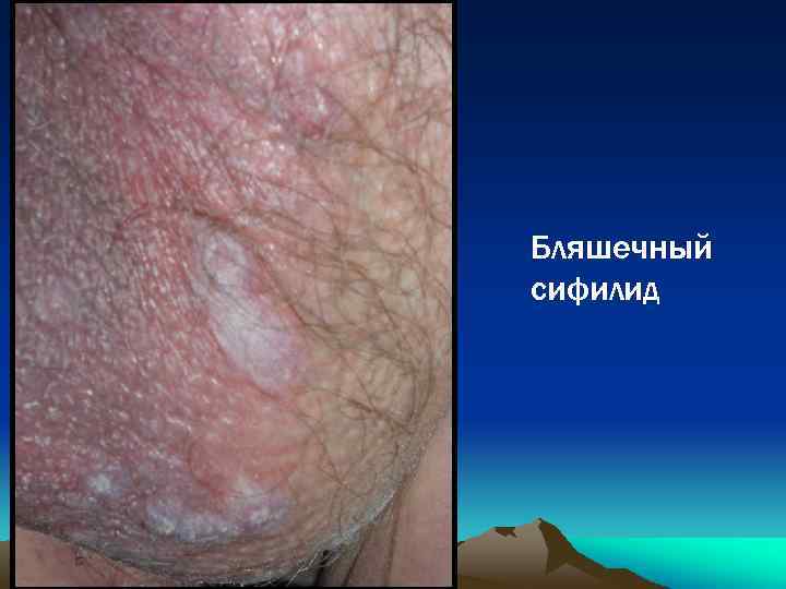 Бляшечный сифилид 