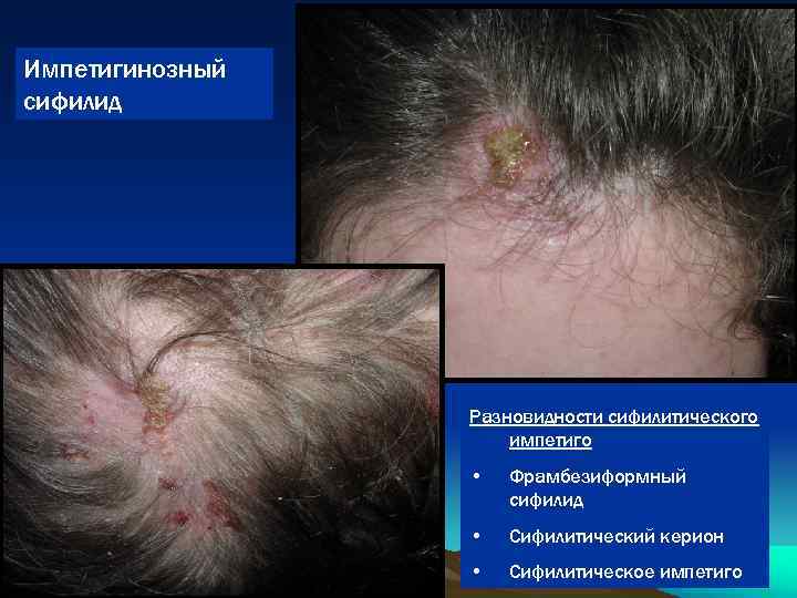 Импетигинозный сифилид Разновидности сифилитического импетиго • Фрамбезиформный сифилид • Сифилитический керион • Сифилитическое импетиго