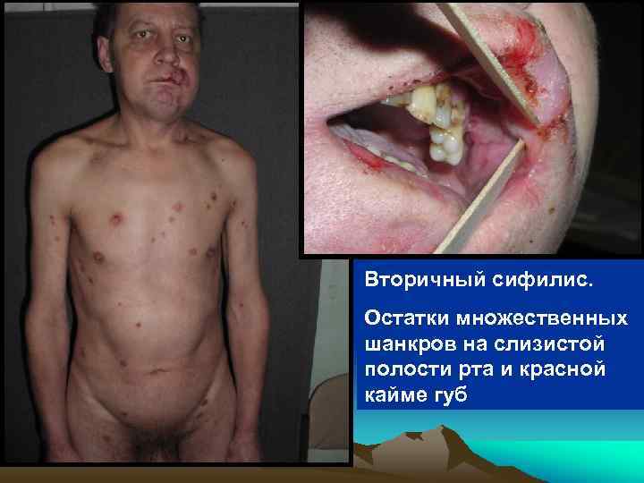 Вторичный сифилис. Остатки множественных шанкров на слизистой полости рта и красной кайме губ 