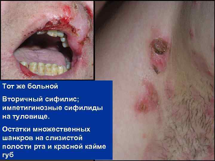 Тот же больной Вторичный сифилис; импетигинозные сифилиды на туловище. Остатки множественных шанкров на слизистой