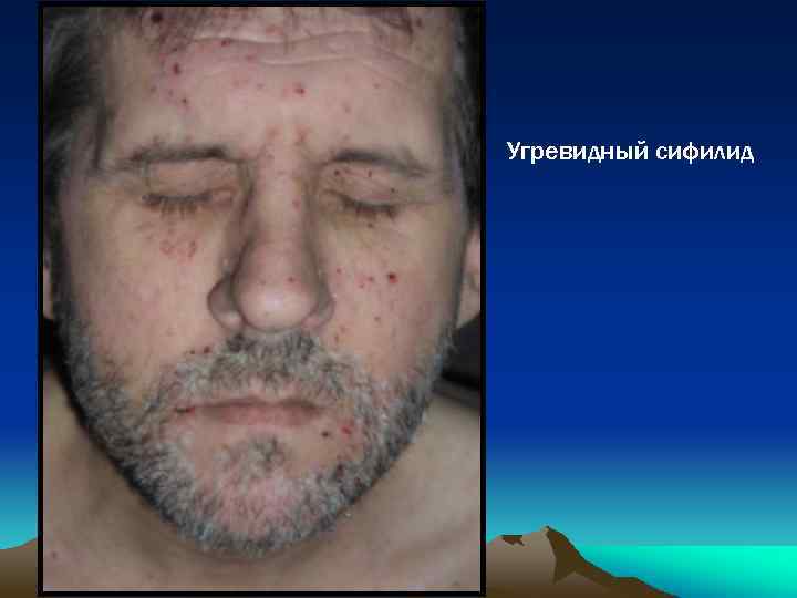 Угревидный сифилид 