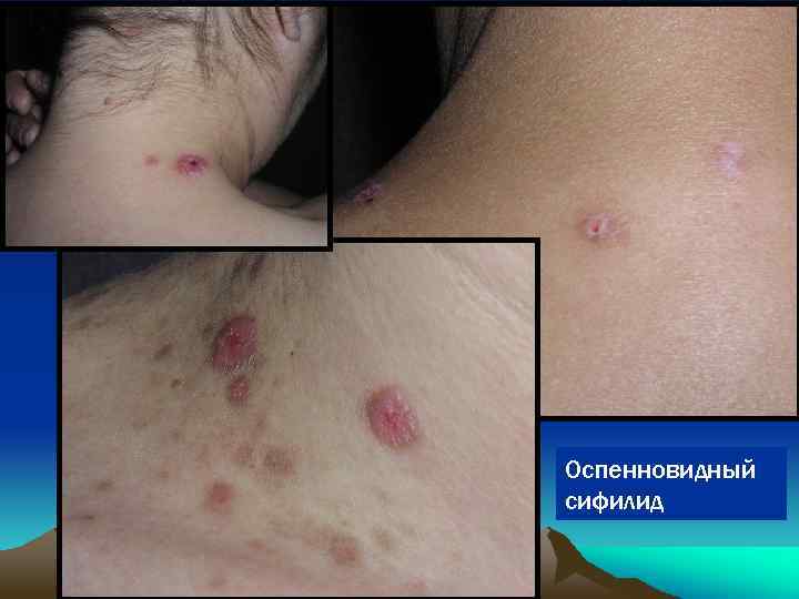 Оспенновидный сифилид 