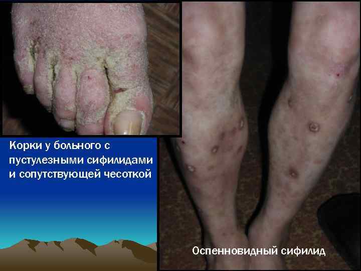 Корки у больного с пустулезными сифилидами и сопутствующей чесоткой Оспенновидный сифилид 