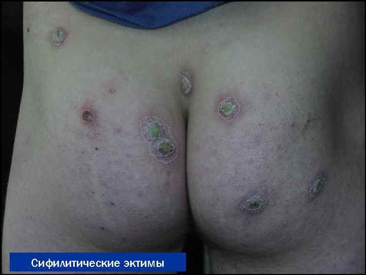Сифилитические эктимы 