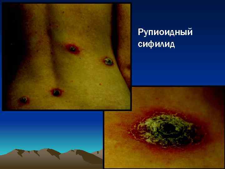 Рупиоидный сифилид 