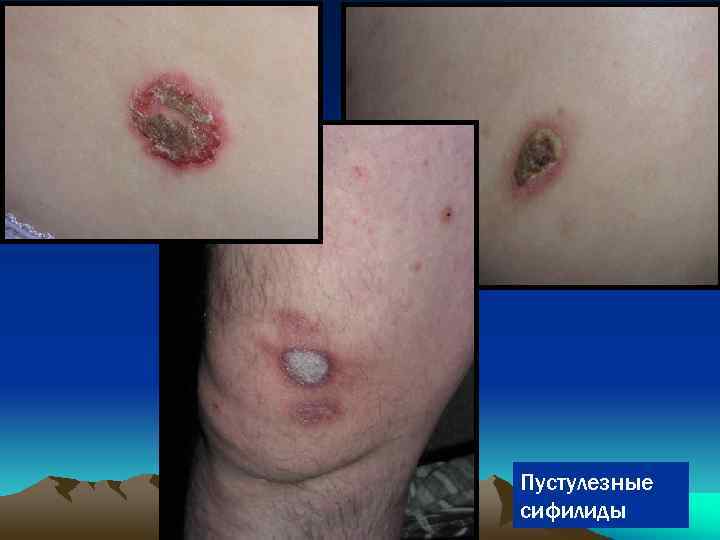 Пустулезные сифилиды 