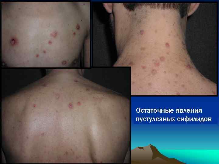 Остаточные явления пустулезных сифилидов 