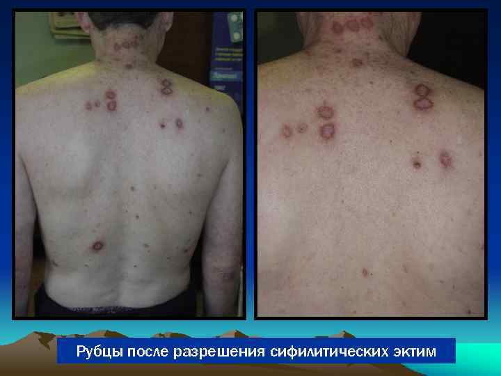 Рубцы после разрешения сифилитических эктим 
