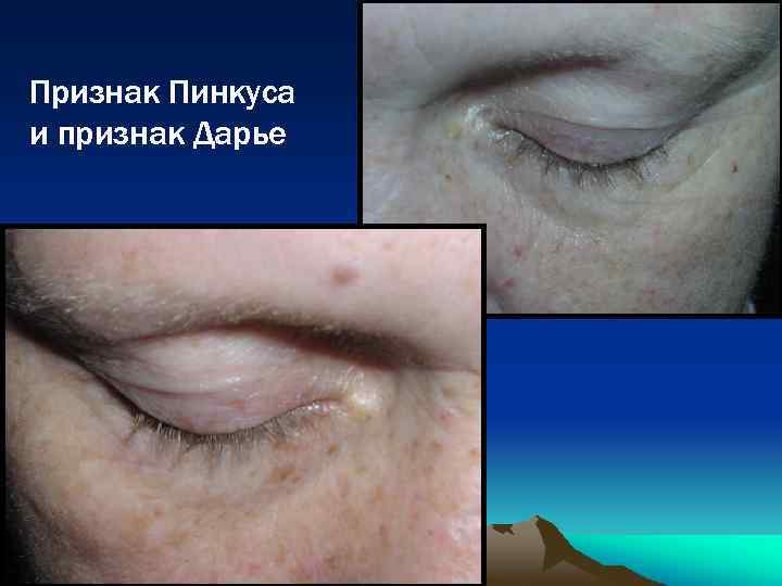 Признак Пинкуса и признак Дарье 