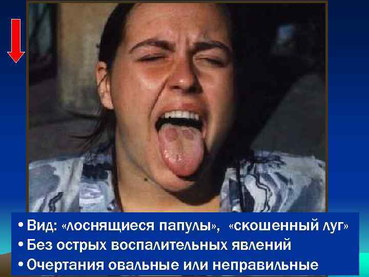  • Вид: «лоснящиеся папулы» , «скошенный луг» • Без острых воспалительных явлений •