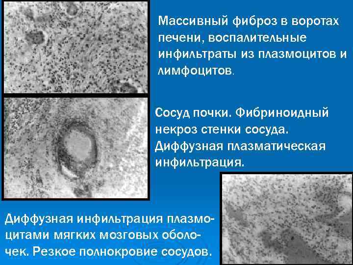 Массивный фиброз в воротах печени, воспалительные инфильтраты из плазмоцитов и лимфоцитов. Сосуд почки. Фибриноидный