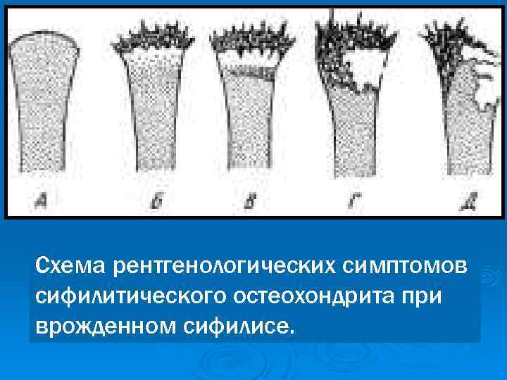 Схема рентгенологических симптомов сифилитического остеохондрита при врожденном сифилисе. 