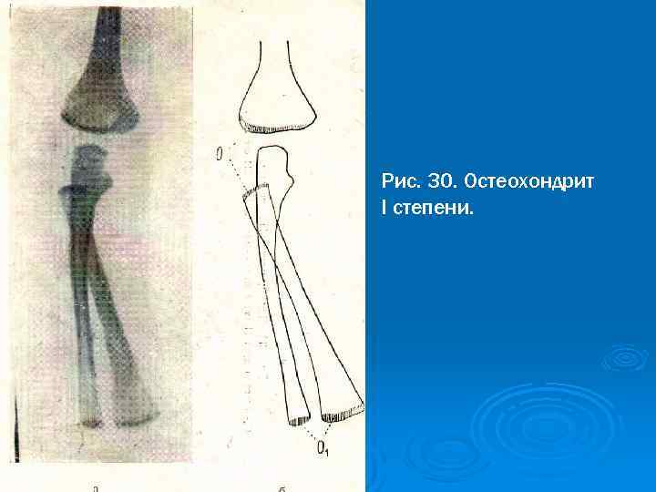 Рис. 30. Остеохондрит I степени. 