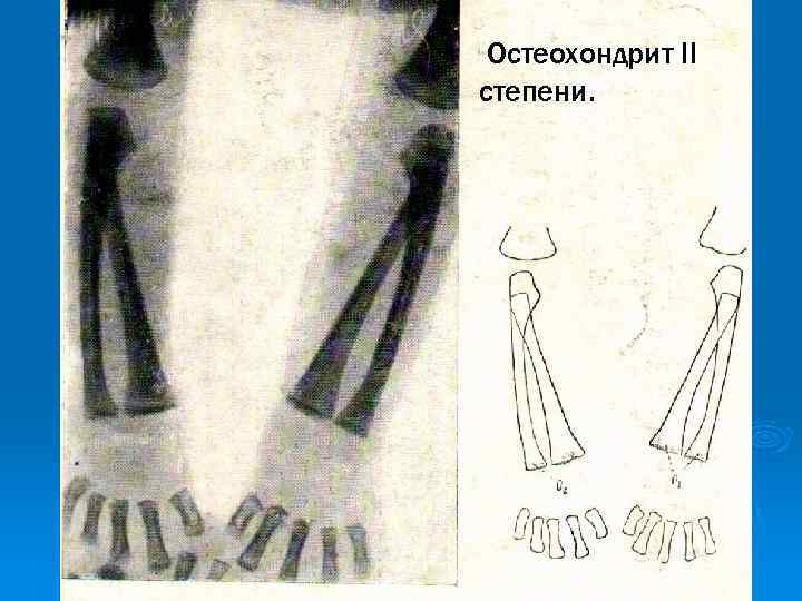 Остеохондрит II степени. 