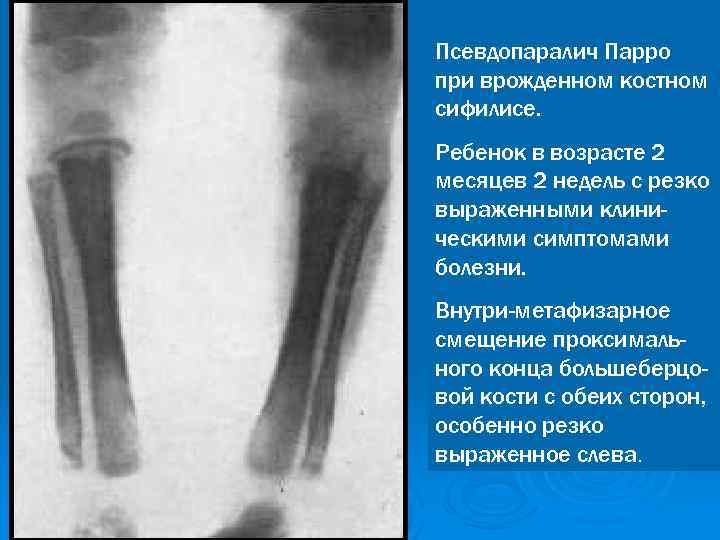 Псевдопаралич Парро при врожденном костном сифилисе. Ребенок в возрасте 2 месяцев 2 недель с