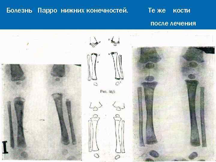 Болезнь Парро нижних конечностей. Те же кости после лечения 