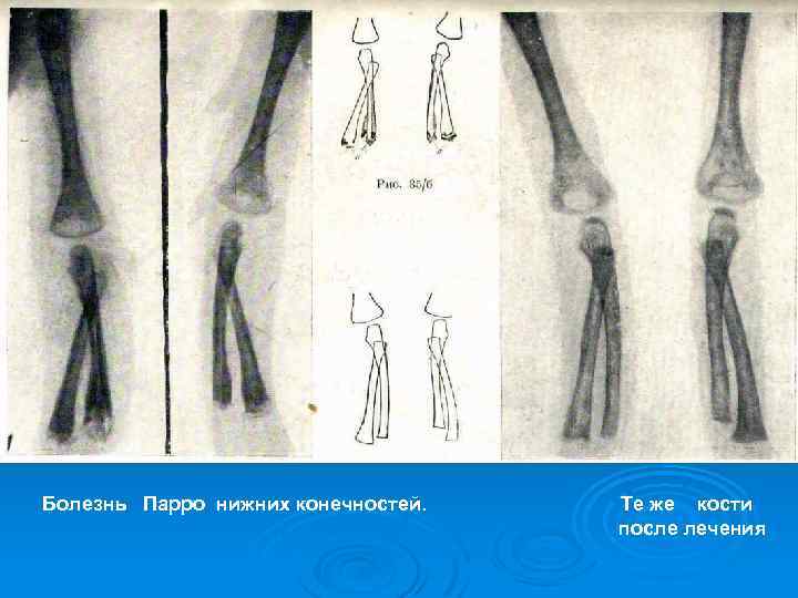 Болезнь Парро нижних конечностей. Те же кости после лечения 