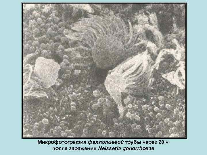 Микрофотография фаллопиевой трубы через 20 ч после заражения Neisseria gonorrhoeae 