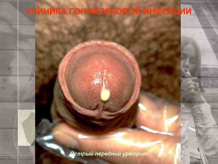 КЛИНИКА ГОНОКОККОВОЙ ИНФЕКЦИИ Острый передний уретрит 