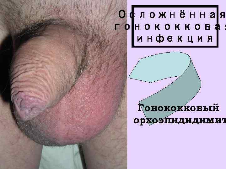 Осложнённая гонококковая инфекция Гонококковый орхоэпидидимит 